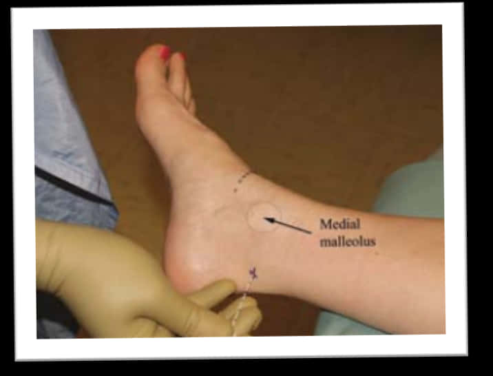 A Patient's Bare Foot And Ankle Can Be Seen Resting - Toe, HD Png Download PNG with transparent background