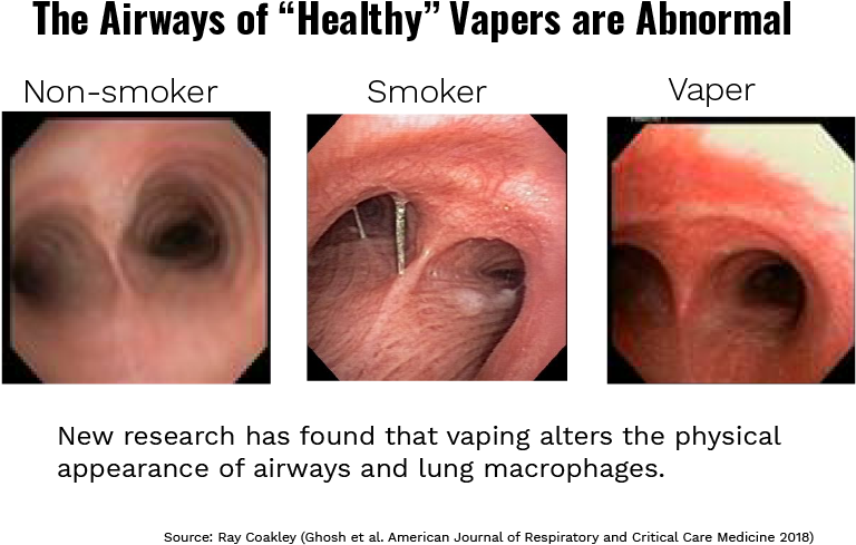 Airway Comparison Non Smoker Smoker Vaper PNG with transparent background