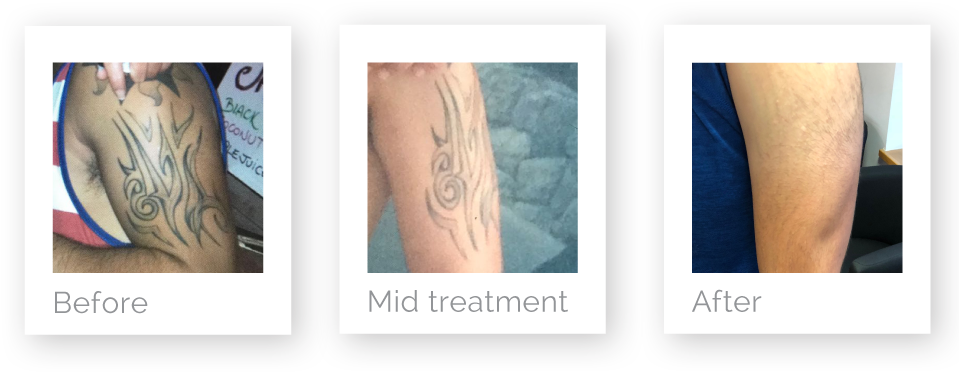 Arm Tattoo Removal Progression