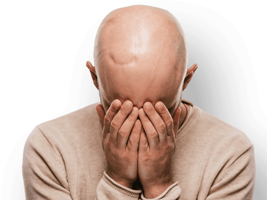 Man With Scarring On Head Holding Hands To Face - Bald Man Crying, HD Png Download PNG with transparent background