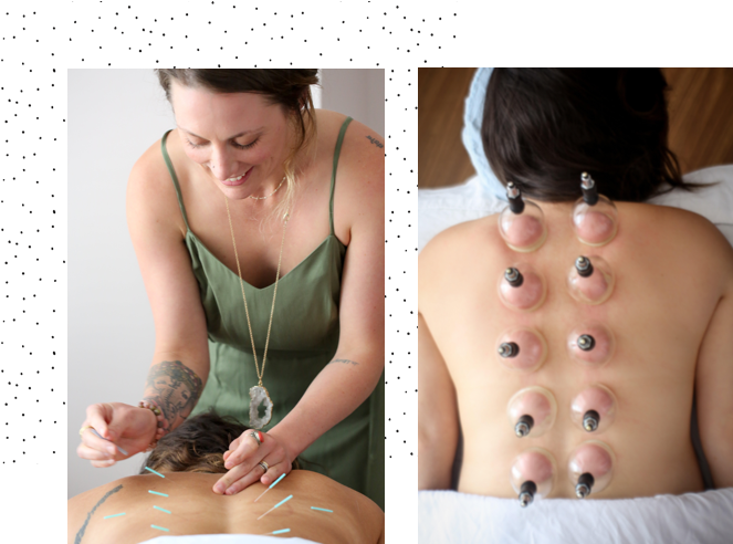 Cupping_and_ Acupuncture_ Therapy_ Session