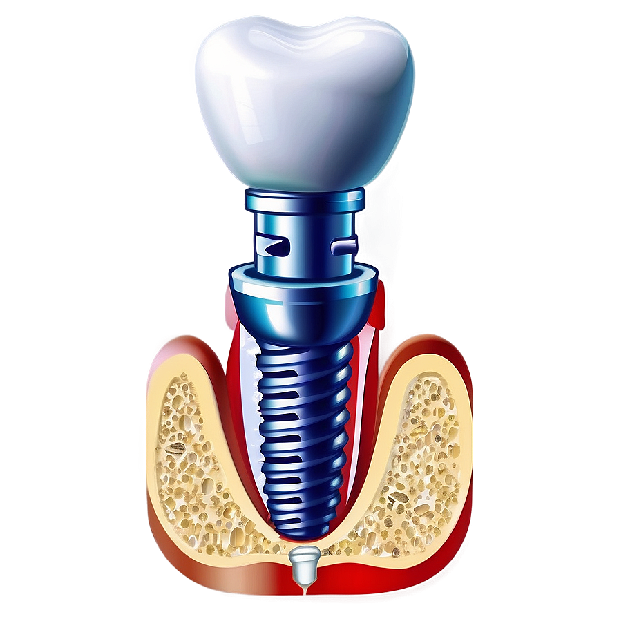 Dental Implants Diagram PNG cpe85 PNG with transparent background