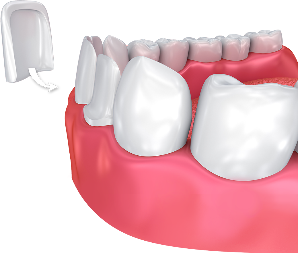 Veneers Teeth, HD Png Download PNG with transparent background