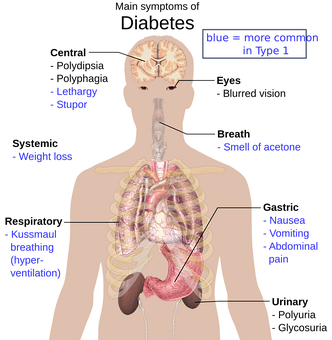 Diabetic Ketoacidosis Symptoms Infographic PNG with transparent background