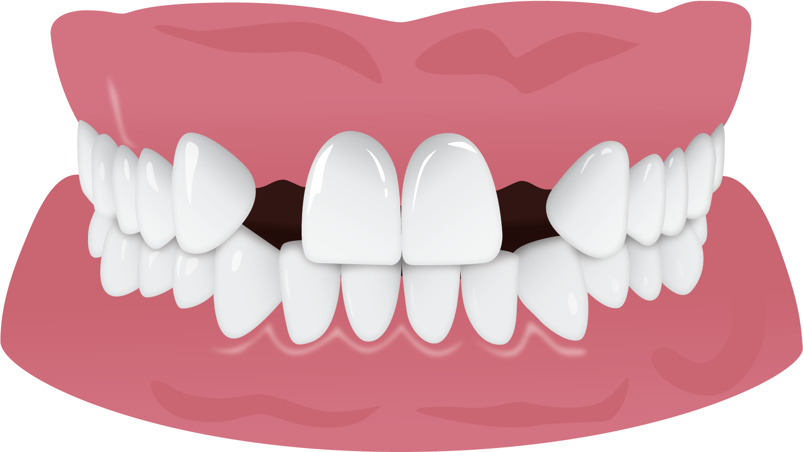 Invisalign Gap Teeth Missing Tooth, HD Png Download PNG with transparent background