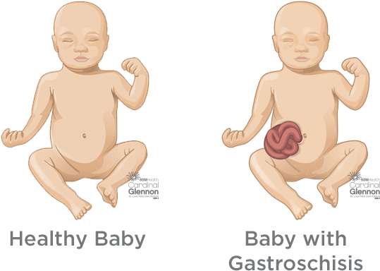 Healthyvs Gastroschisis Baby Comparison