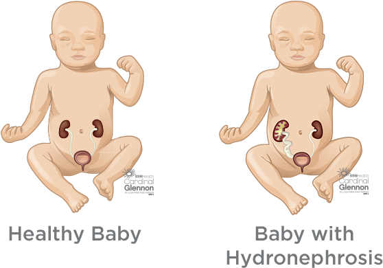 Healthyvs Hydronephrosis Baby Comparison