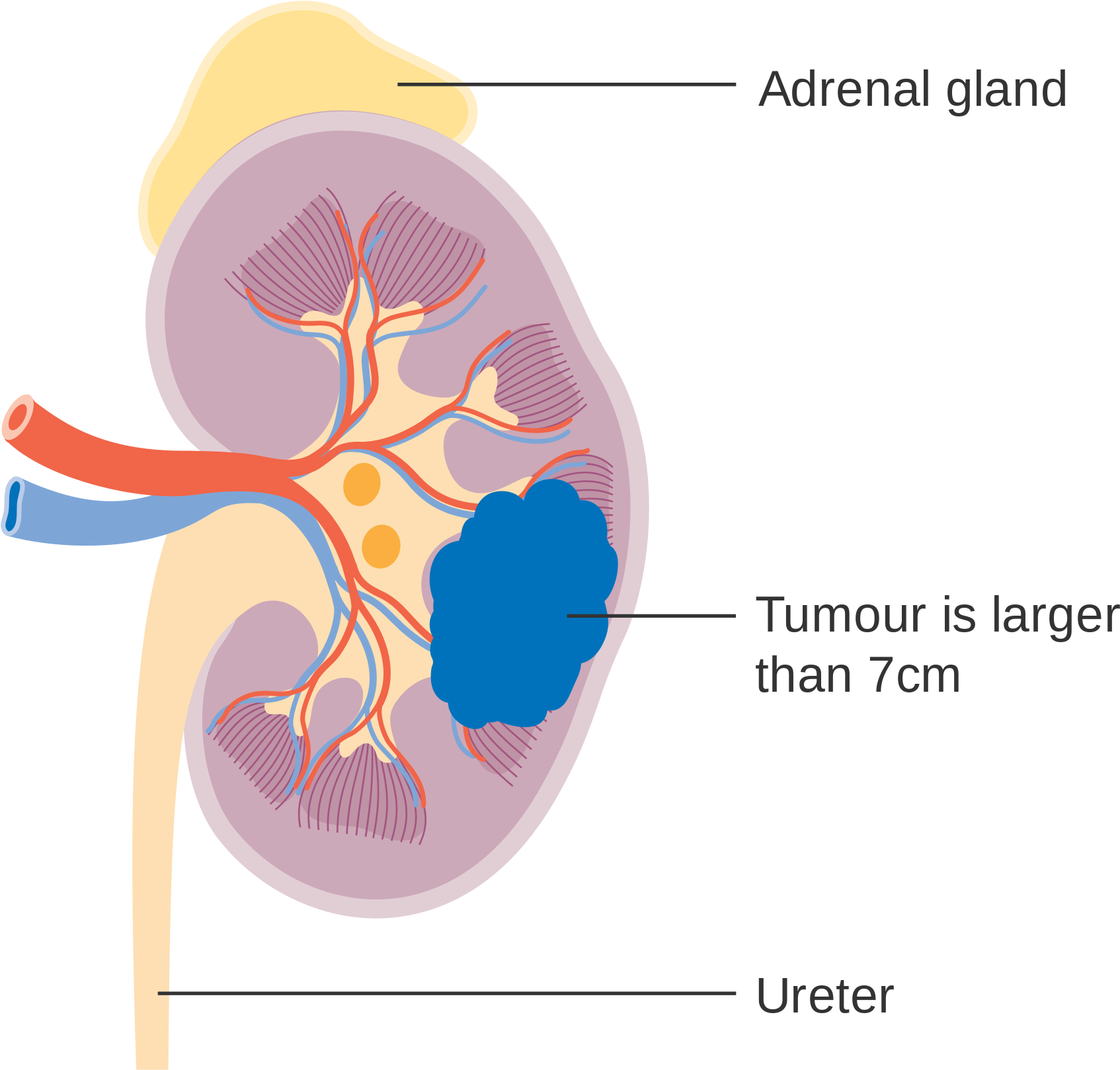 Kidney Anatomywith Tumor Illustration