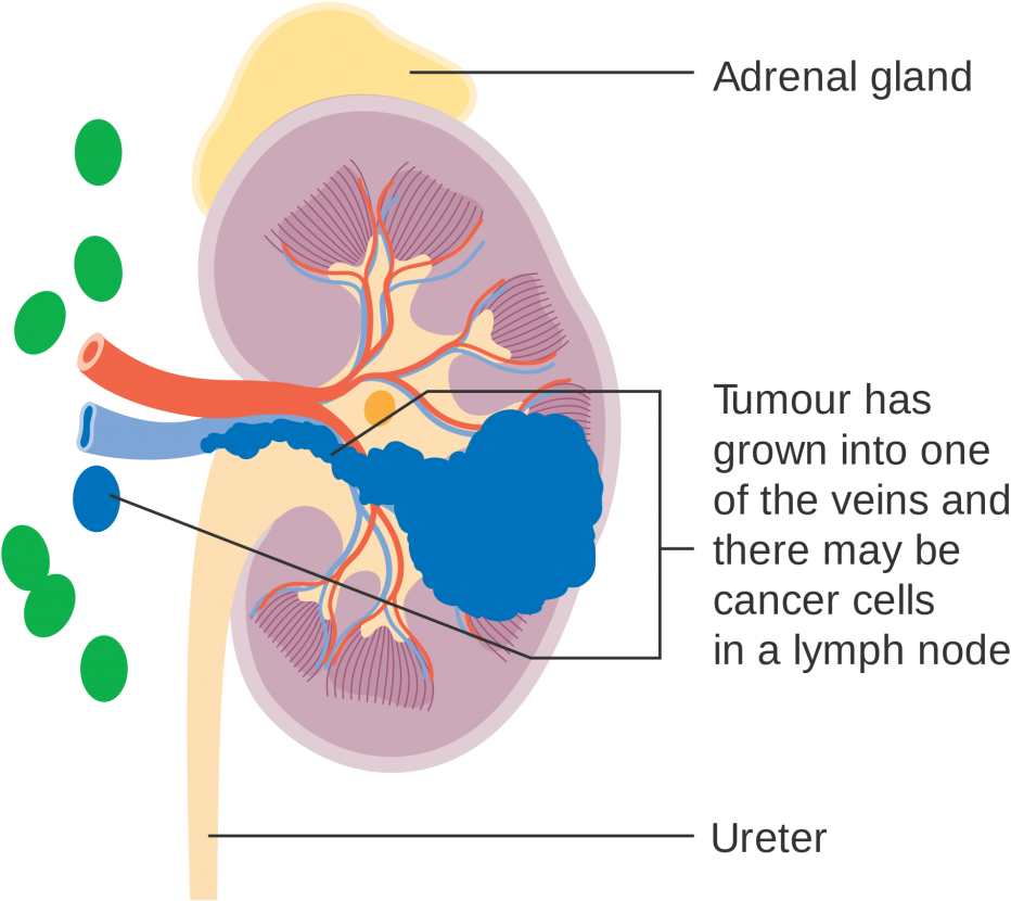 Kidney Cancer Surgery - Stage 1 Kidney Cancer, HD Png Download PNG with transparent background