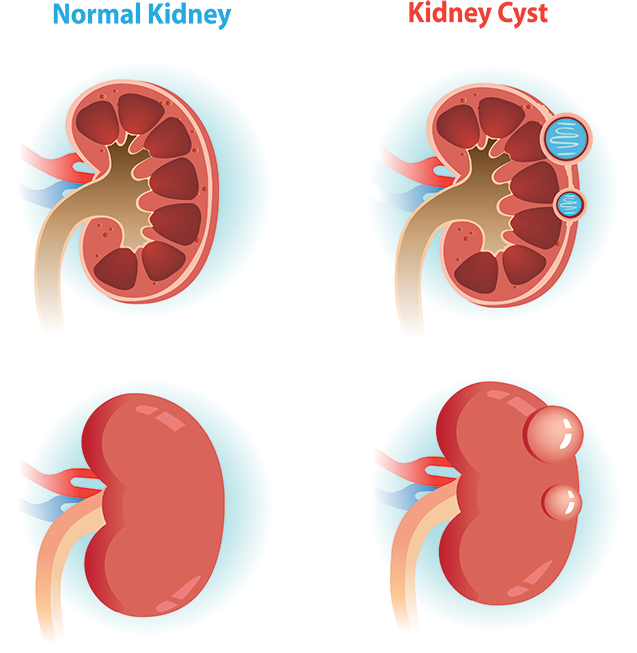 Comparison Of Normal Kidney Verse A Kidney With A Cyst - Kidney Cyst, HD Png Download PNG with transparent background