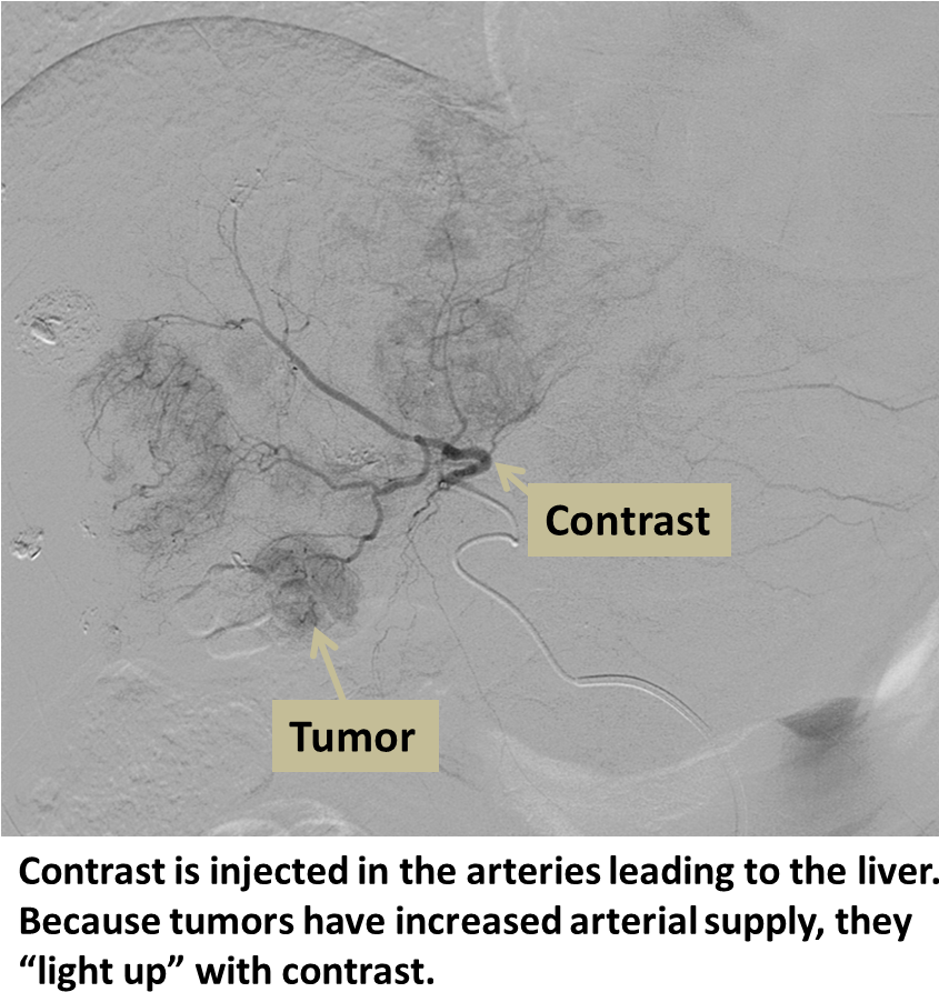 Liver Angiogram Tumor Detection PNG with transparent background