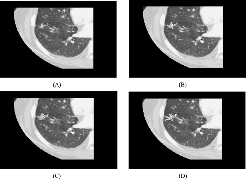 White Outline Shows Contour From Three Different Readers - Lung PNG image with a transparent background, free high-resolution download