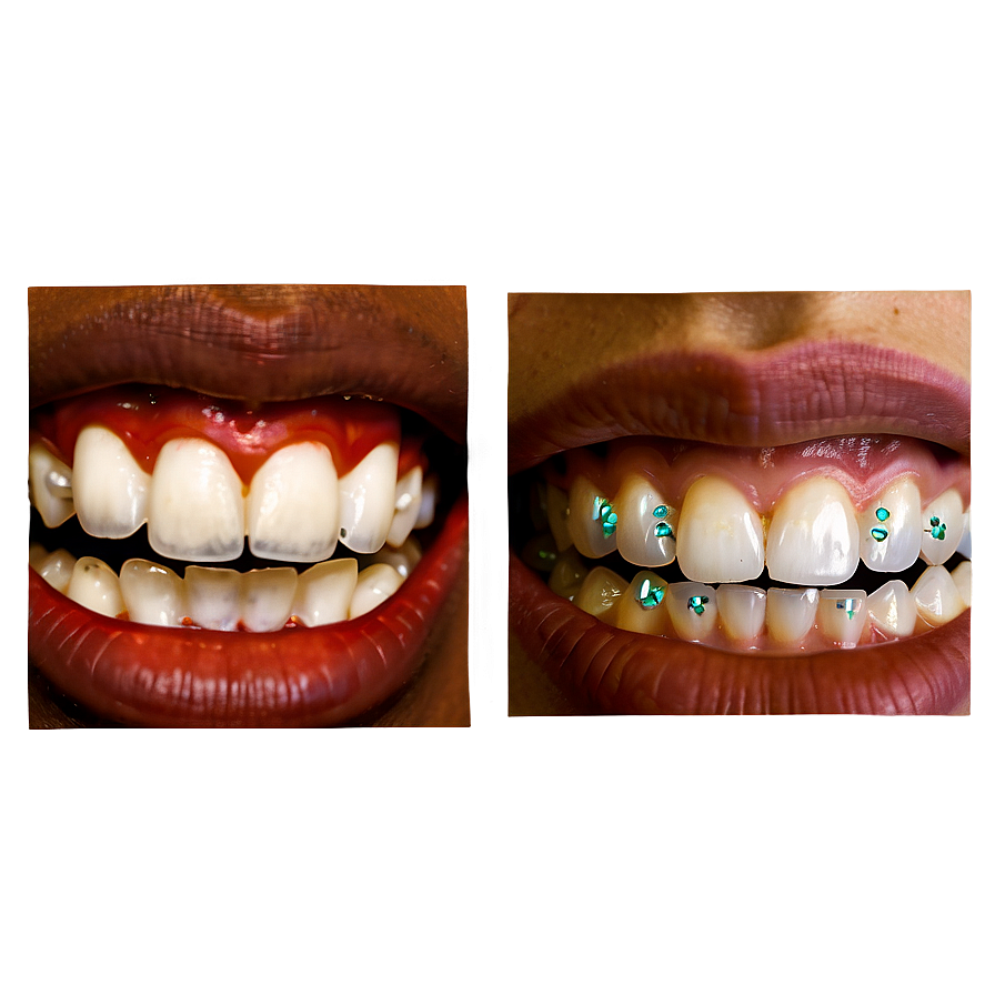 Mouth with Braces PNG ogq11 PNG image with a transparent background, free high-resolution download