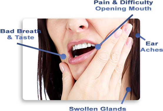 What Are The Wisdom Teeth - Wisdom Tooth Removal Pain PNG with transparent background