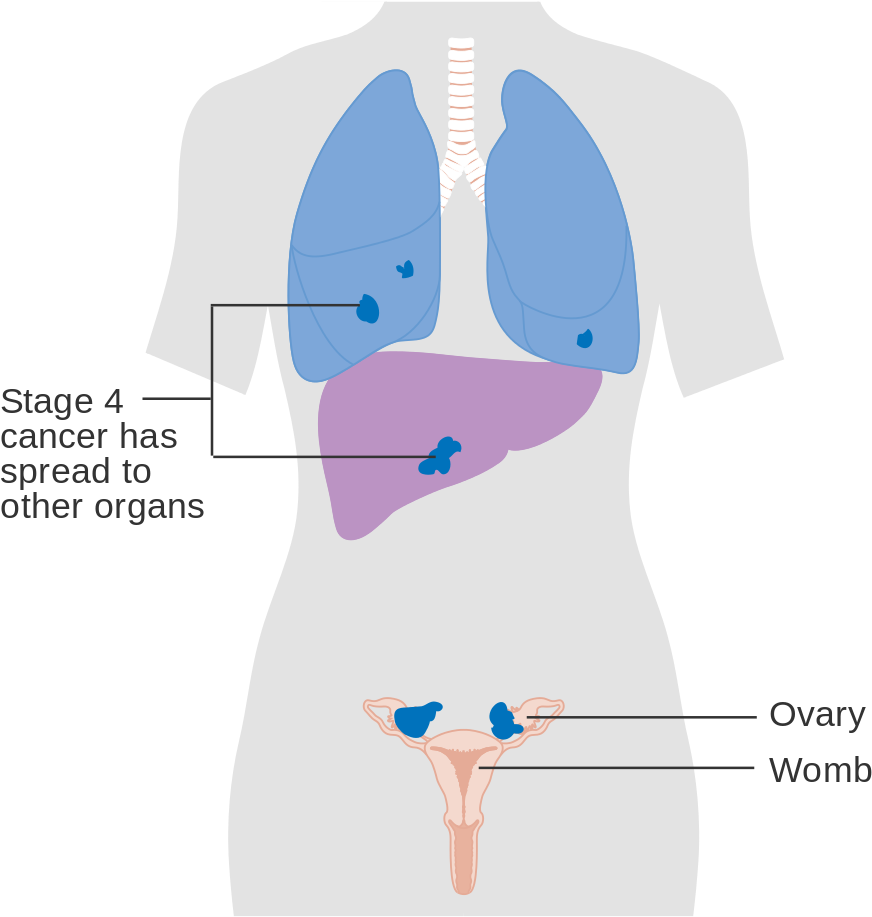 Stage4 Cancer Spread Illustration PNG with transparent background