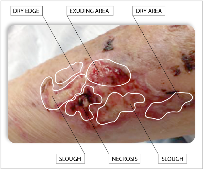 Desiccation Wound, HD Png Download PNG with transparent background