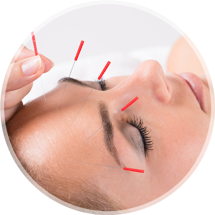 Acupuncture_ Therapy_for_ Headache PNG Image