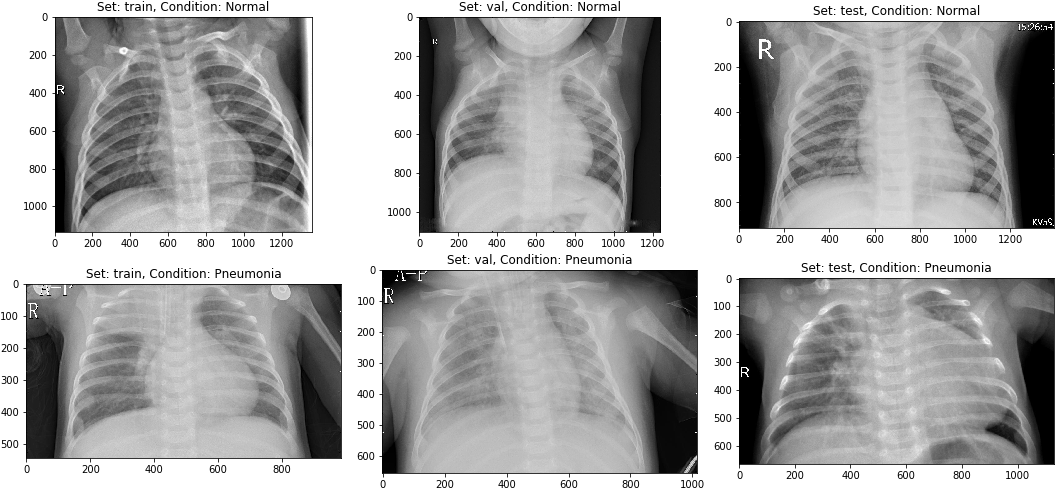 Chest_ Xray_ Comparison_ Normal_vs_ Pneumonia PNG Image