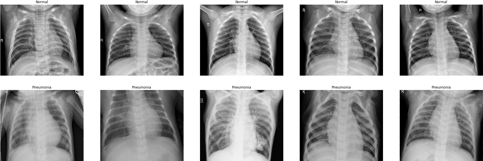 Chest Xray Comparison Normalvs Pneumonia PNG Image