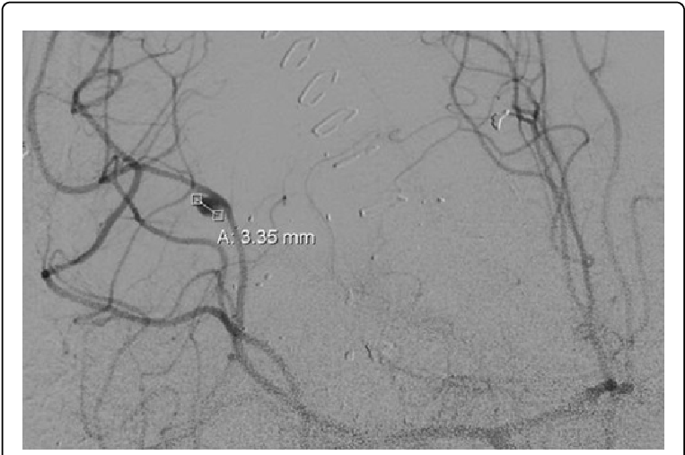 Coronary_ Angiogram_with_ Stent_ Placement PNG Image