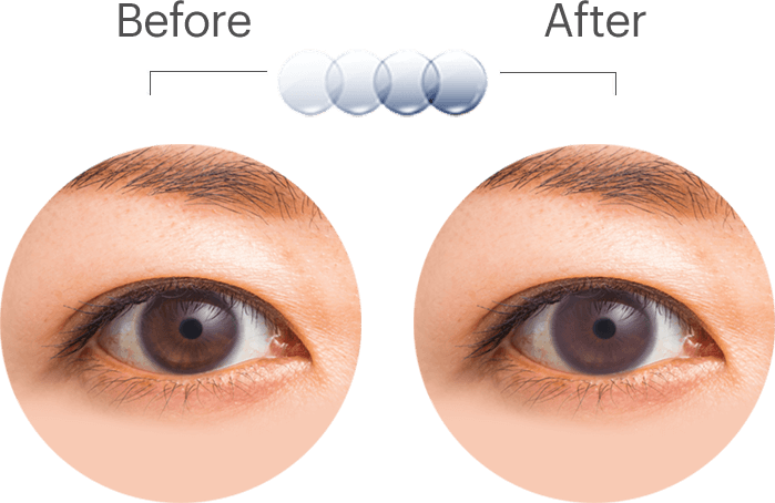 Eye Treatment Before After PNG Image