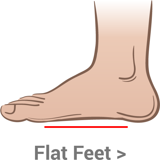 Flat Foot Condition Illustration PNG Image