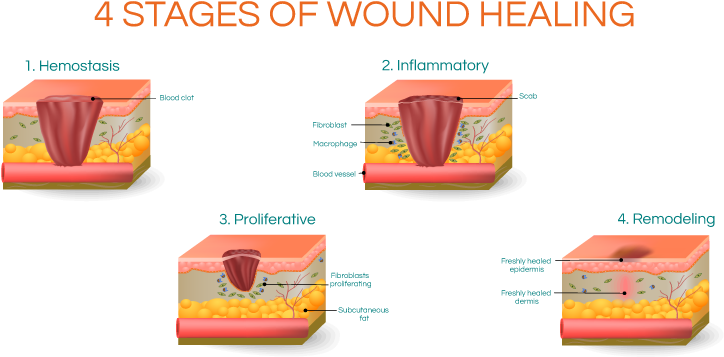 Four Stagesof Wound Healing Graphic PNG Image