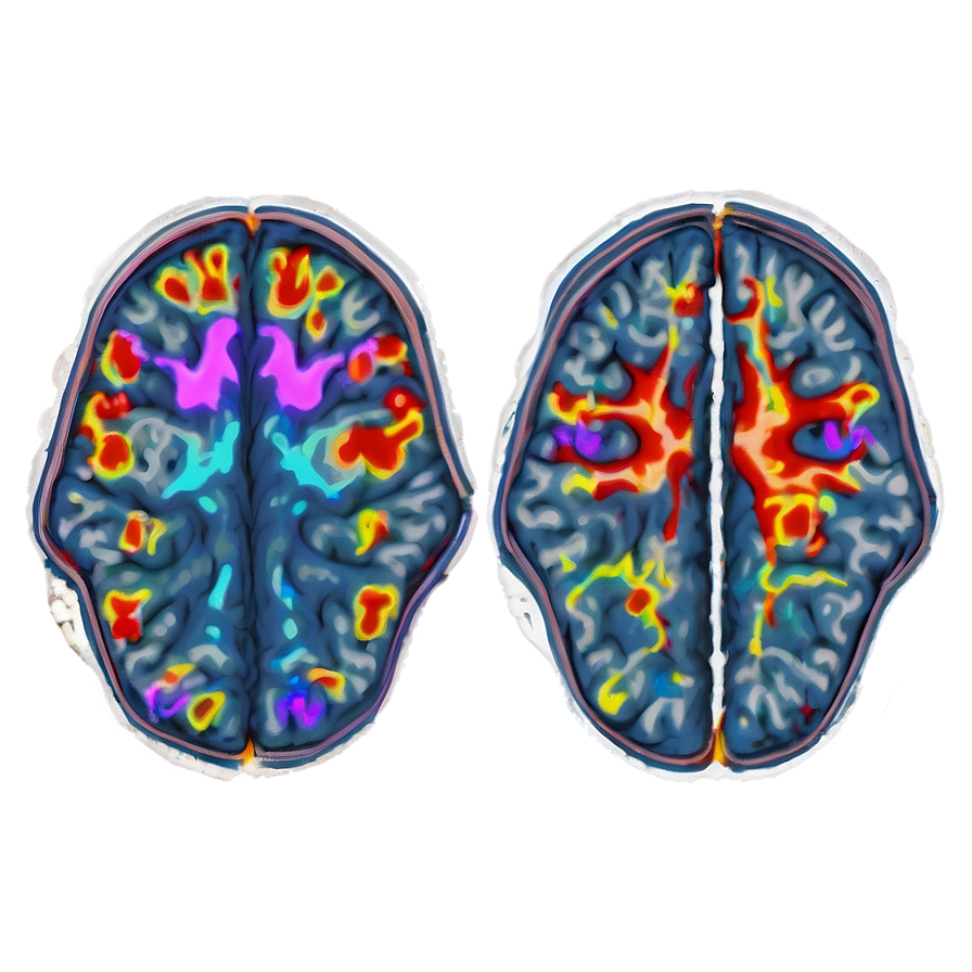 Functional Mri Brain Mapping Png Nhs PNG Image