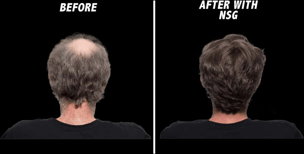 Hair Restoration Before After N S G PNG Image