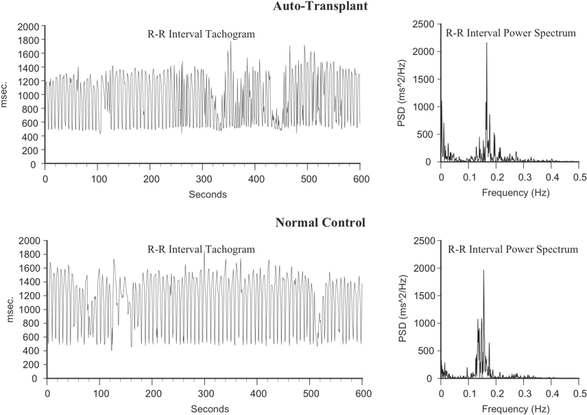 Heart Rate Variability Comparison Auto Transplantvs Normal Control PNG Image