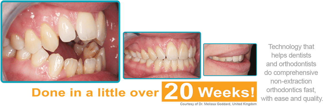 Orthodontic Treatment Progress20 Weeks PNG Image