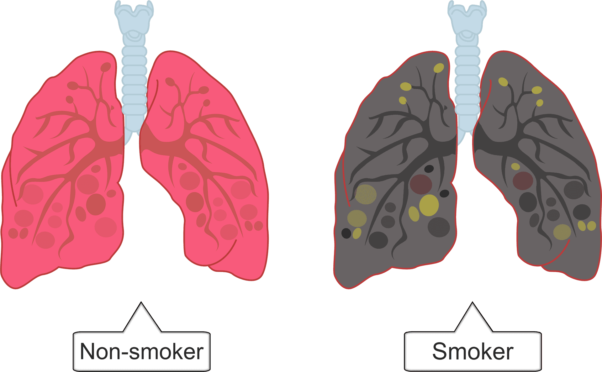 Smokervs Non Smoker Lung Comparison PNG Image