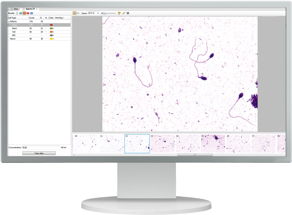 Sperm Analysis Microscopic View PNG Image