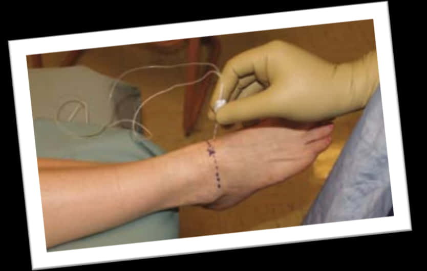 Suturing Wound Care Procedure PNG Image