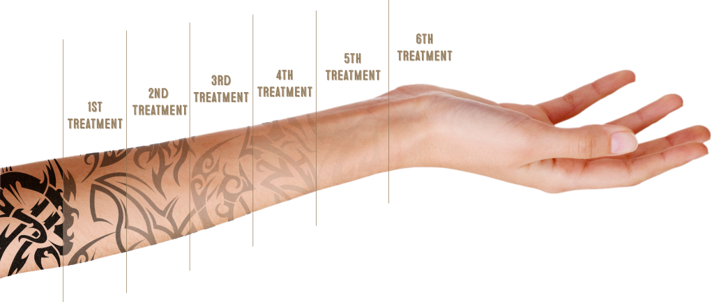 Tattoo Removal Progression Arm PNG Image