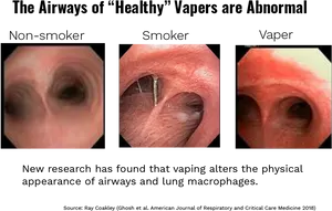 Airway Comparison Non Smoker Smoker Vaper PNG Image