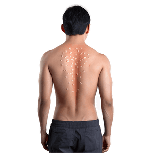 Back Acne Treatment Solutions PNG 06252024 PNG with transparent background