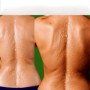 Back Acne Treatment Solutions PNG 71 PNG with transparent background