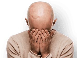 Man With Scarring On Head Holding Hands To Face - Bald Man Crying, HD Png Download PNG image with transparent background