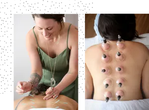 Cupping_and_ Acupuncture_ Therapy_ Session PNG Image