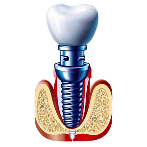 Dental Implants Diagram PNG cpe85 PNG with transparent background
