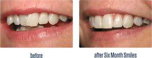 Dental_ Transformation_ Before_ After PNG Image