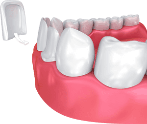 Veneers Teeth, HD Png Download PNG image with transparent background