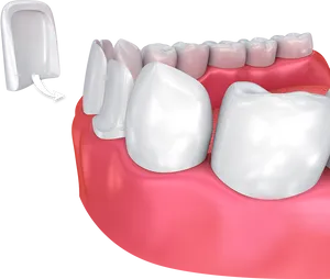 Dental Veneer Placement3 D Illustration PNG Image