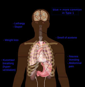 Diabetic Ketoacidosis Symptoms Infographic PNG image with transparent background