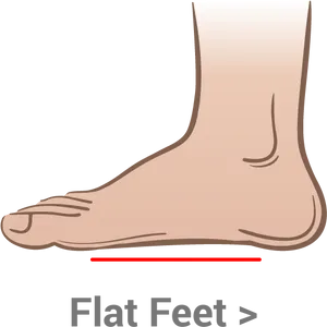 Flat Foot Condition Illustration PNG Image