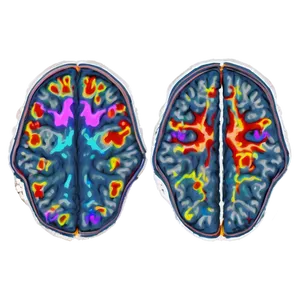 Functional Mri Brain Mapping Png Nhs PNG Image