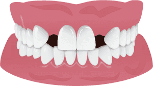 Invisalign Gap Teeth Missing Tooth, HD Png Download PNG image with transparent background