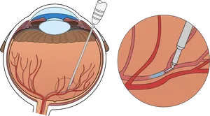 Intravitreal Injection Eye Treatment PNG Image