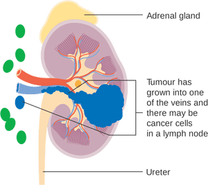 Kidney Cancer Surgery - Stage 1 Kidney Cancer, HD Png Download PNG with transparent background